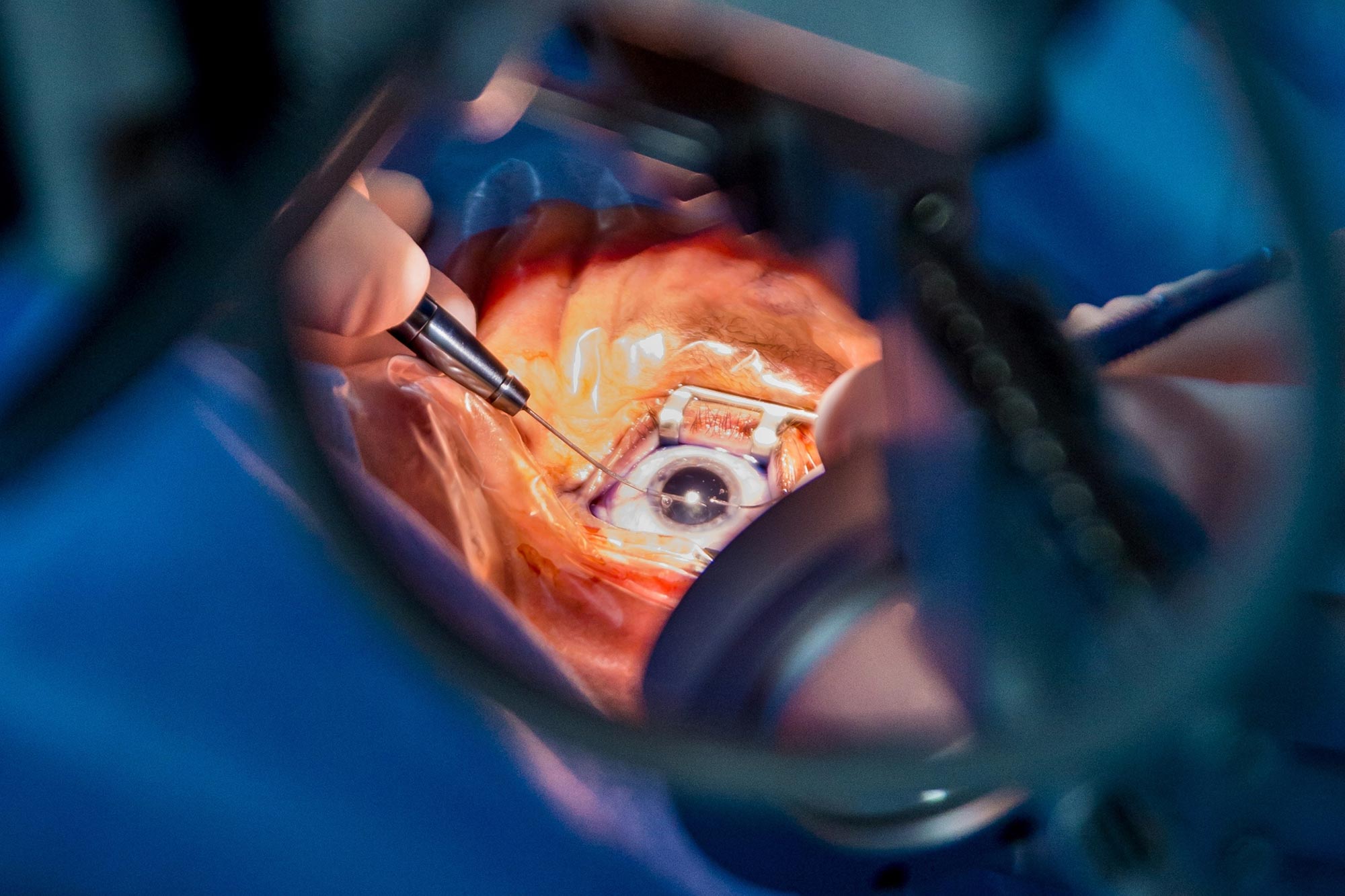 Everything You Should Know About Cataract Surgery