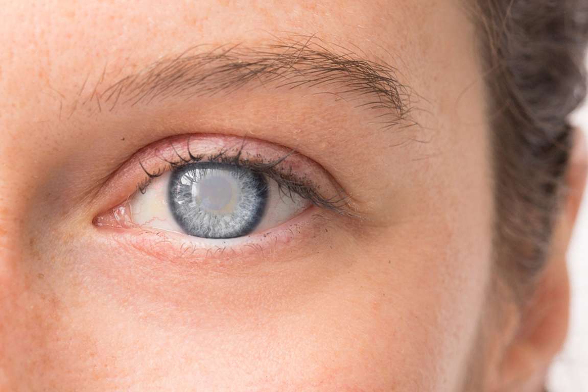 How To Treat A Dry Eye Disease Flare-Up After Cataract Surgery